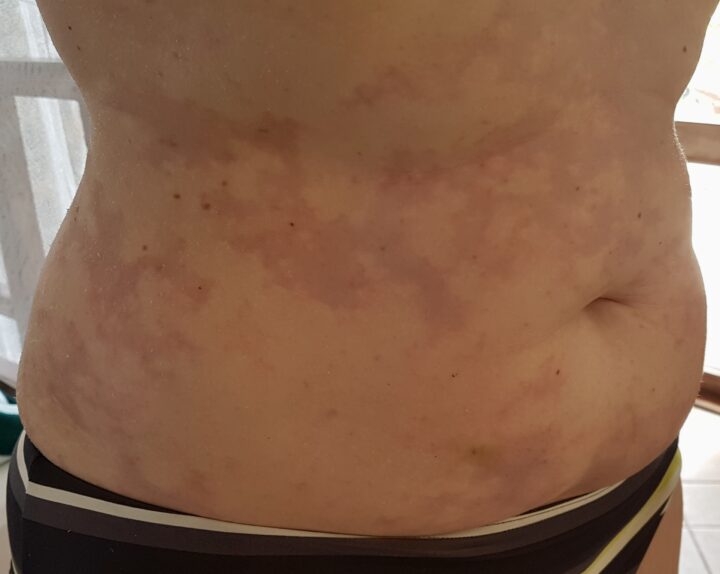 Livedo racemosa bei Tauchern: Hautveränderung als mögliches DCI-Symptom